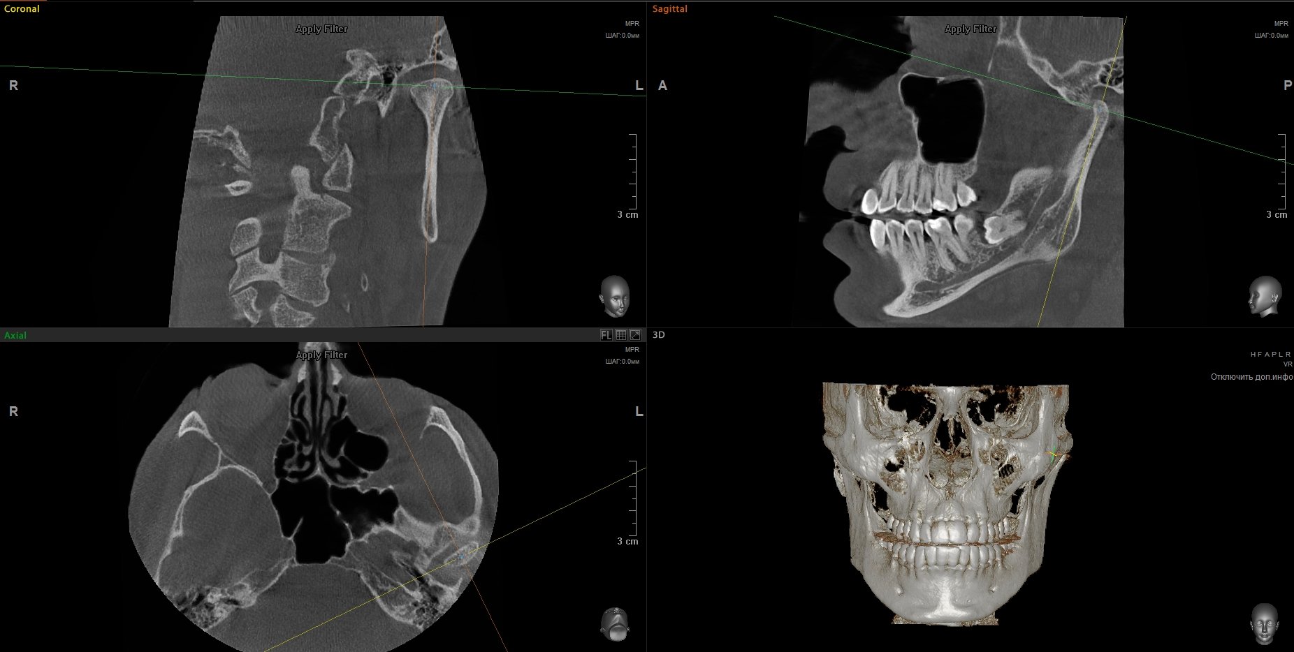 Detailed imaging of the jaws and the mandibular joint