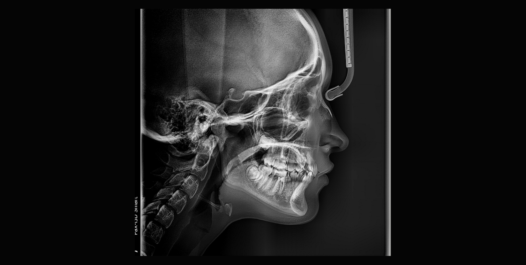 Teleroentgenography