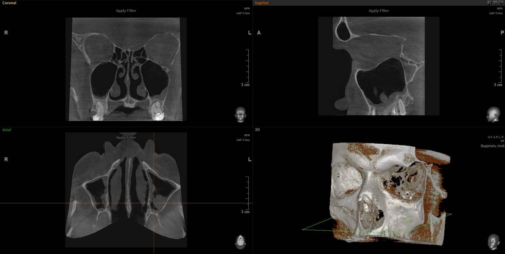 Imaging of the paranasal sinuses