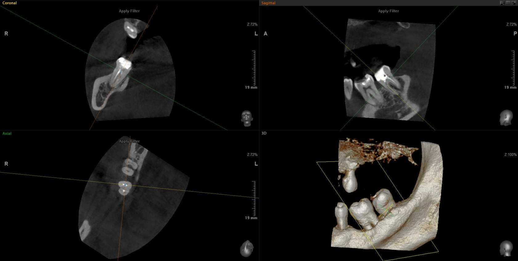Detailed imaging of a 5×5 cm segment, typically 2-3 teeth