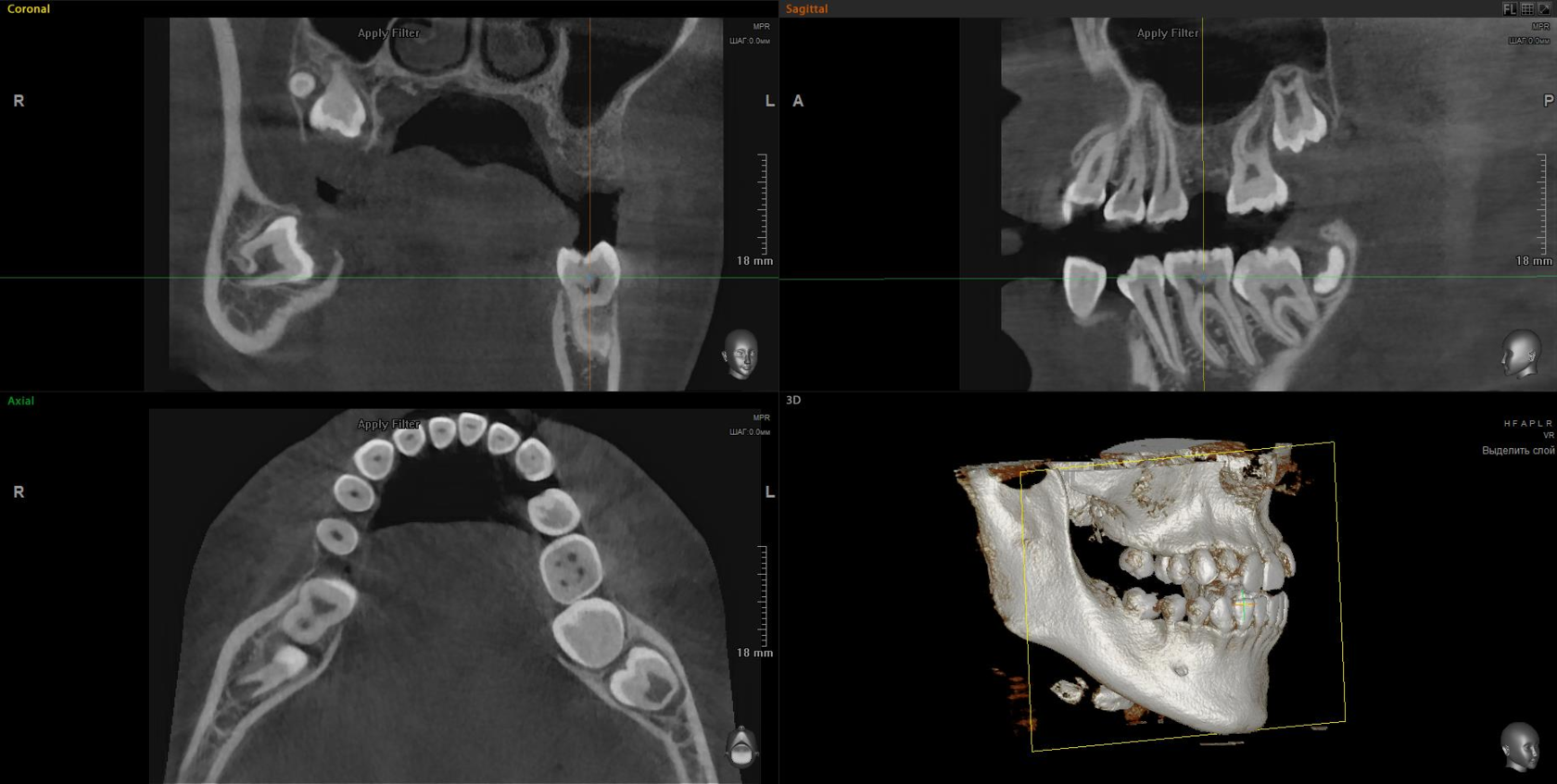 Computed tomography of the jaws