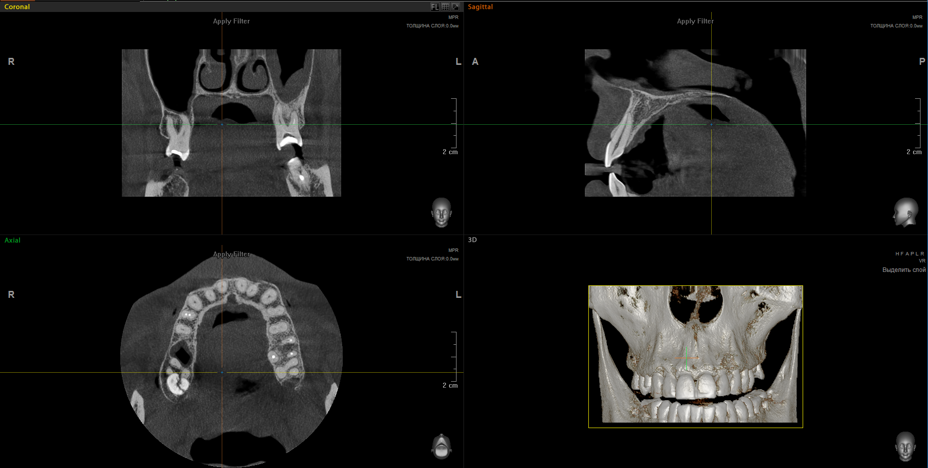 Computed tomography of one jaw