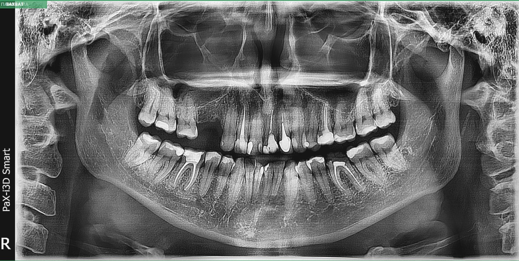 Panoramic tomography of dentitions