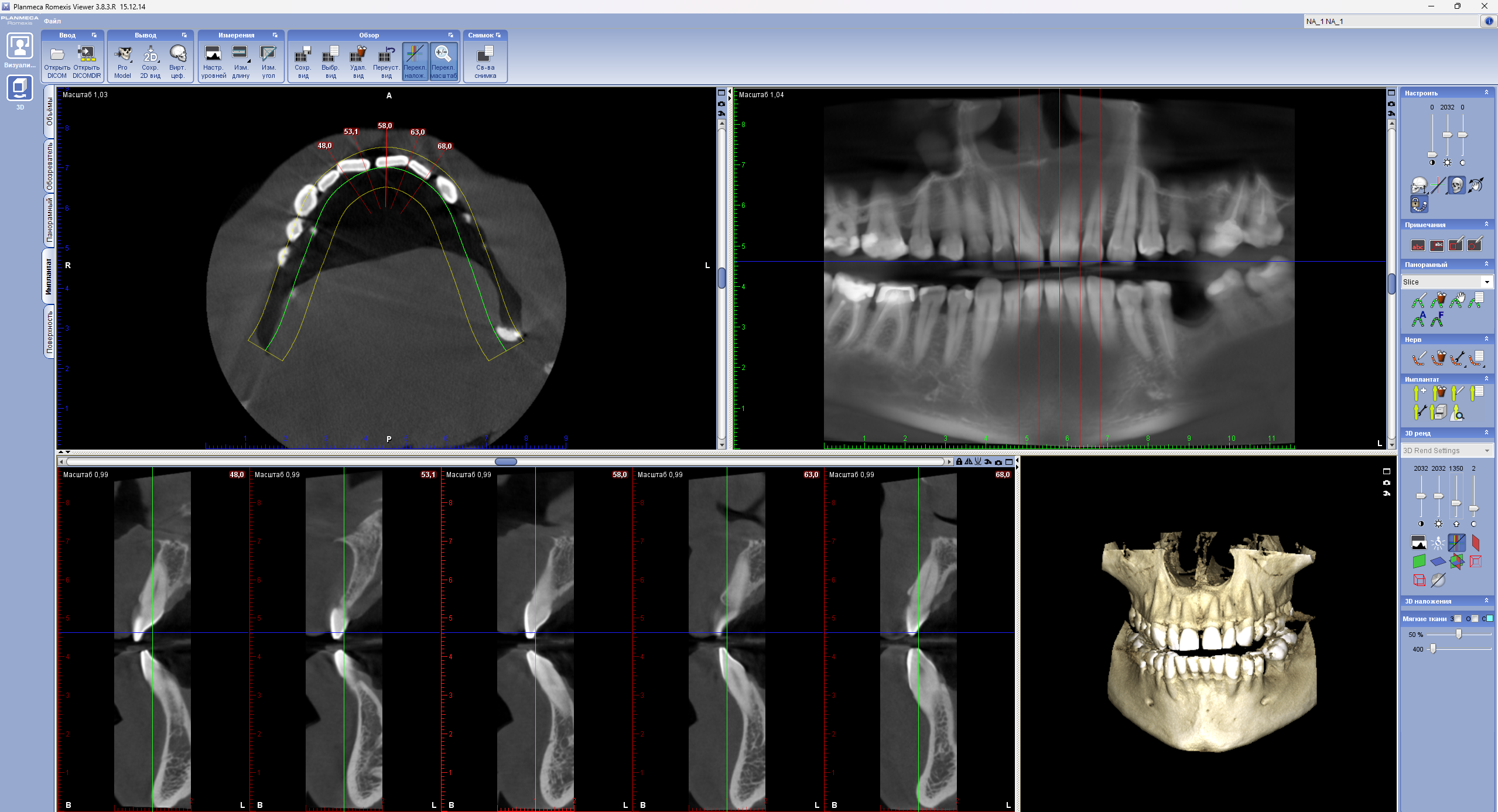 Romexis Implant View